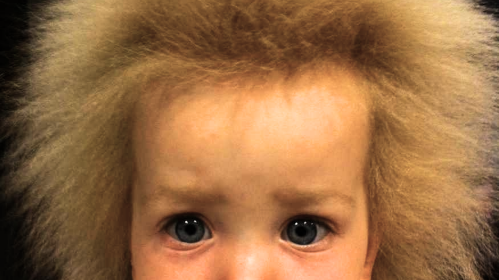 Girl with Uncombable Hair Syndrome staring into camera